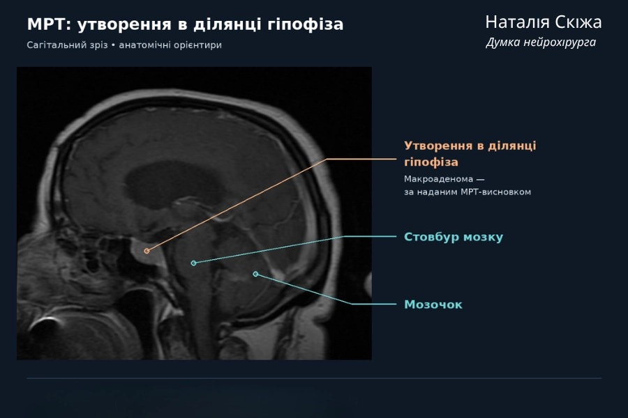 «Пацієнт може добре читати, але вже мати зміни периферичного зору. Тому при контакті утворення із зоровим перехрестям важлива перевірка полів зору — комп’ютерна периметрія», — зазначає Наталія Скіжа.